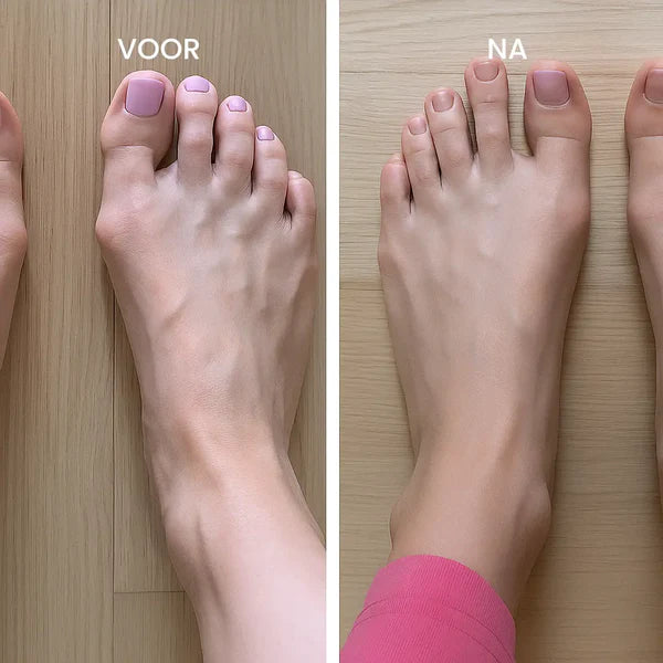 Valgux™ Brace | Teencorrector bij scheefstand (Hallux Valgus)